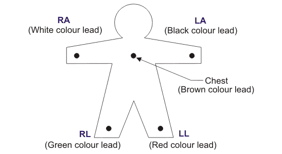 双极肢体引线或标准引线